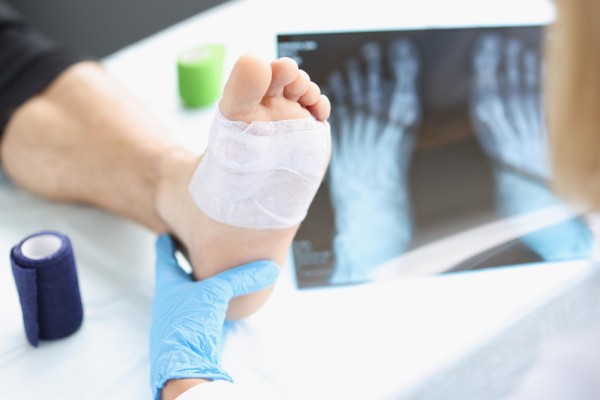 Fracture Rehabilitation